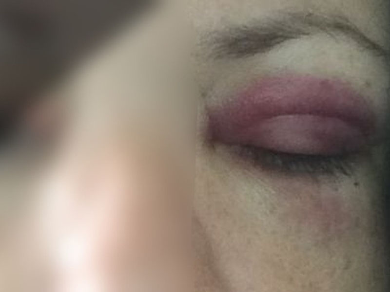Enfermeira de Marília faz desabafo na web e posta foto após ser agredida pelo marido